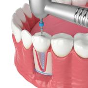 Root Canal